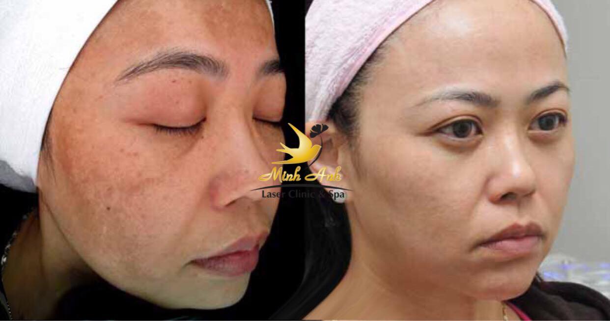 Nguyên nhân xuất hiện nám và cách điều trị hiệu quả